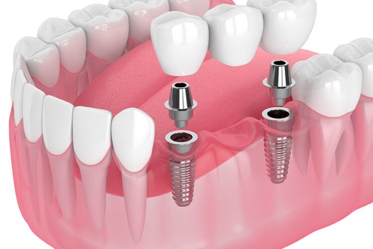 single and multiple dental implant main e1689855110928