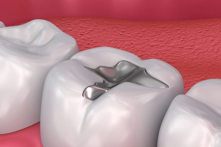 dental fillings min 750x750 1